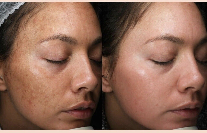 Before and after comparison arfter using clinique even better clinical dark spot corrector +interputer