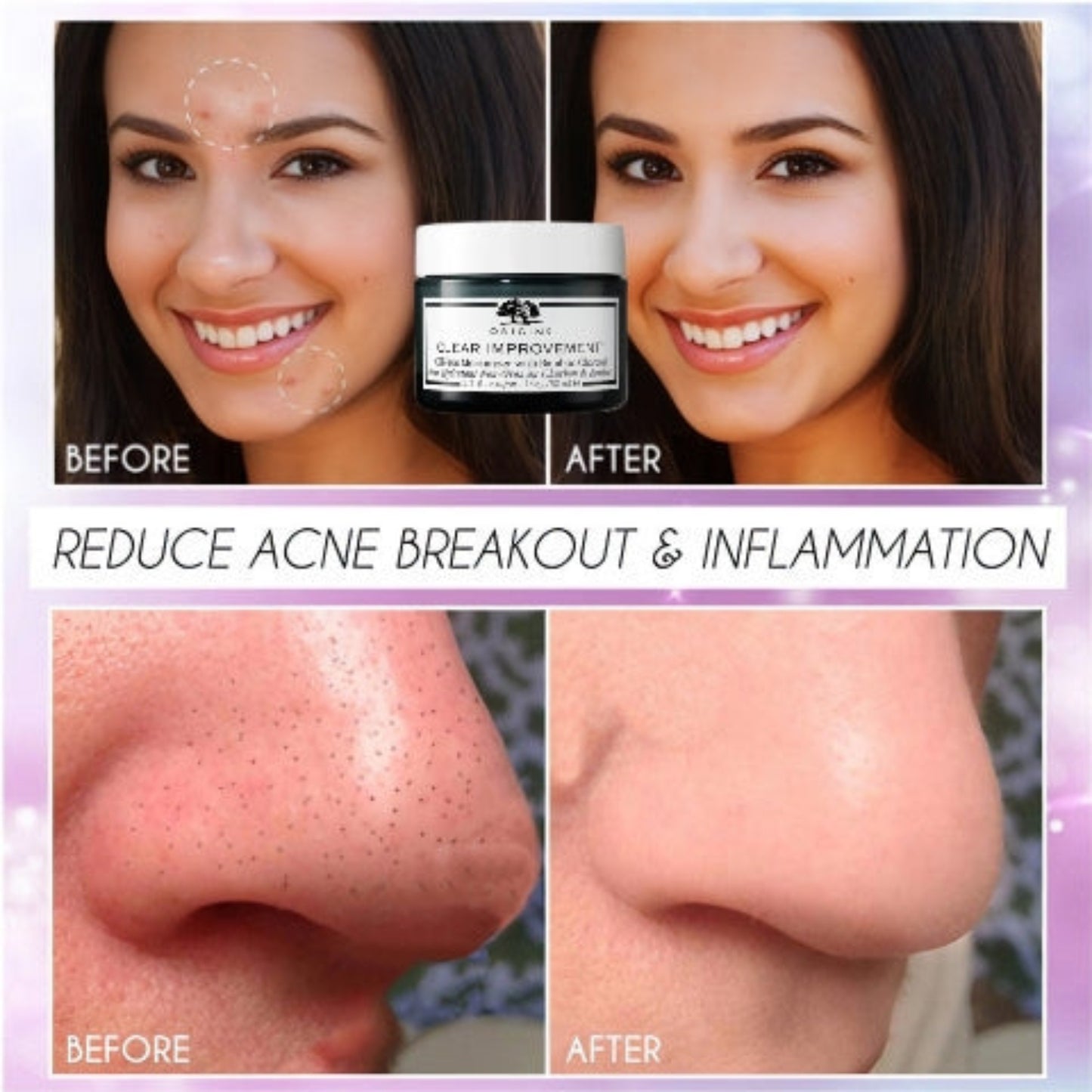 Origins Clear Improvement Oil-Free Moisturizer With Bamboo Charcoal before and after